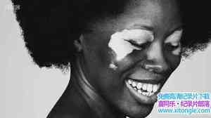 BBC¼Ƭ硪ҵƤ Radio Stories My Extraordinary Skin 2017ӢӢ-