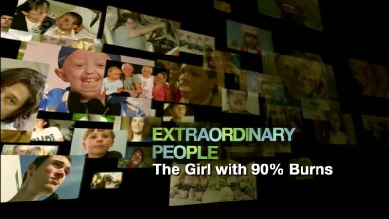 ¼Ƭ90%˵Ů/The Girl With 90 Percent Burns-Ļ