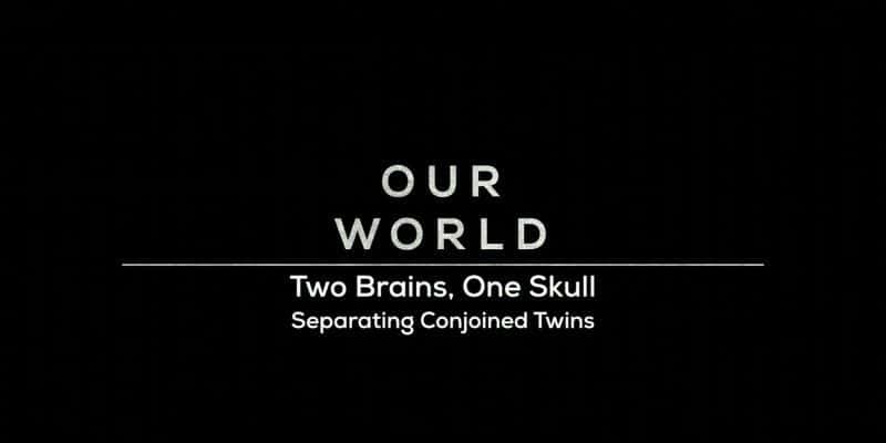 ¼ƬӤ/Separating Conjoined Twins-Ļ