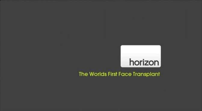 ¼Ƭϵһ沿ֲ/The World's First Face Transplant-Ļ