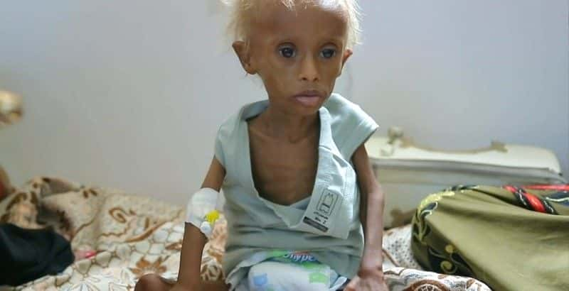 ¼ƬҲ Starving Yemenȫ1-Ļ/Ļ