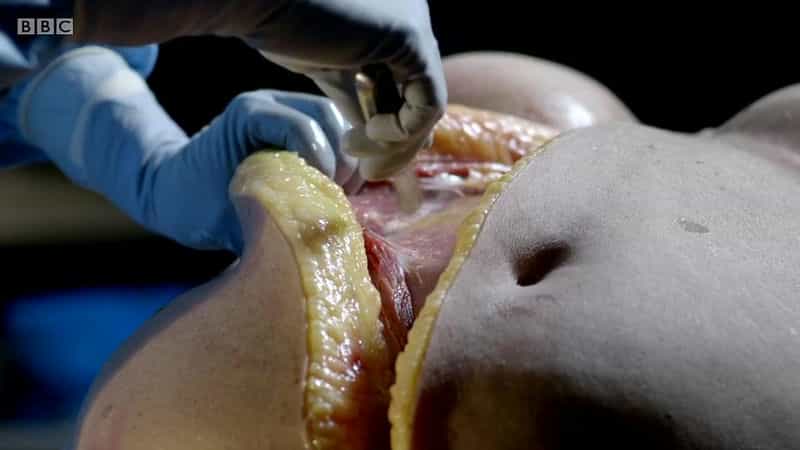 纪录片《解剖肥胖  Obesity: The Post Mortem》（2016英国）--高清4K/1080P迅雷BT资源下载