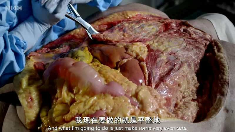 纪录片《解剖肥胖  Obesity: The Post Mortem》（2016英国）--高清4K/1080P迅雷BT资源下载