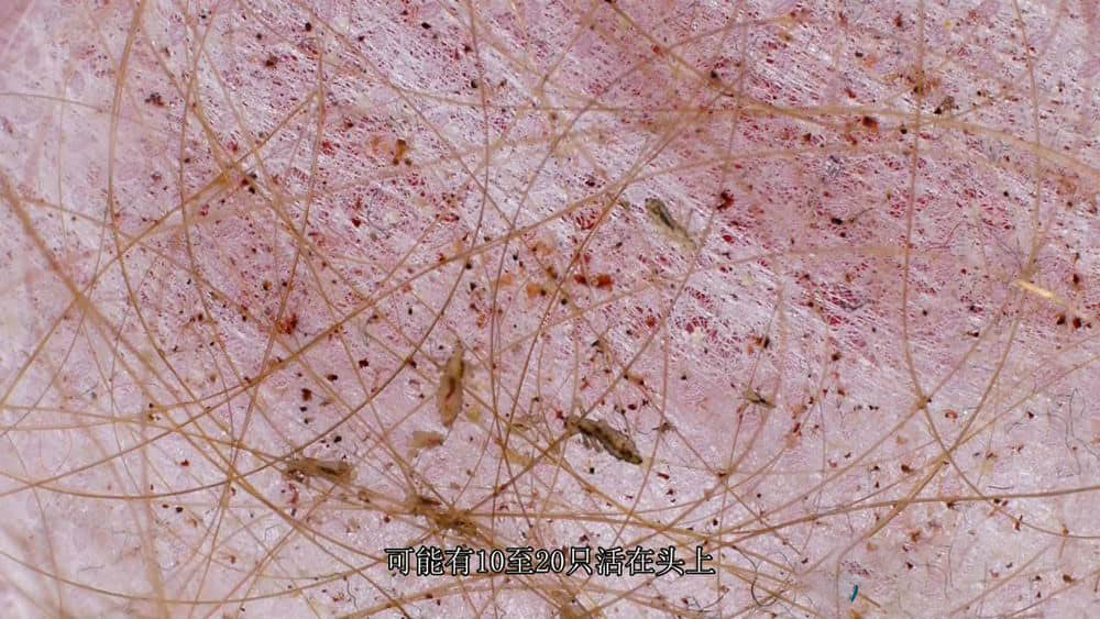 BBC纪录片《与寄生虫共存 Infested Living with Parasites》[全1集][中英双字][720P][网盘][资源下载]